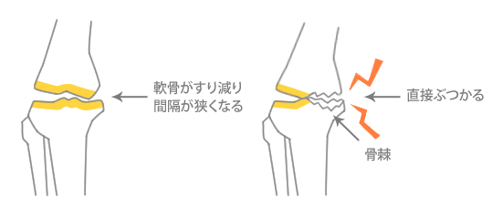 変形性膝関節症の図