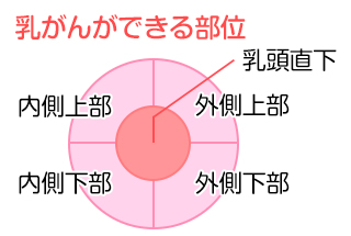 乳がんの種類の図