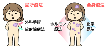 乳がん治療の図