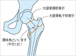 大腿部頚部骨折