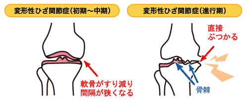 変形性膝関節症の症状