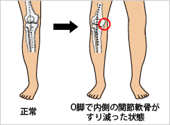 外見的にも関節の変形が目立つ