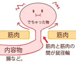 腸などが『脱出』した状態の図