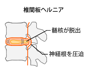 椎間板ヘルニア画像