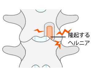 ヘルニアの画像