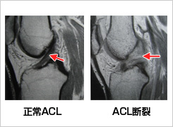 ACL損傷のMRI