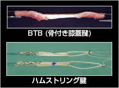 ACL再建術の再建材料