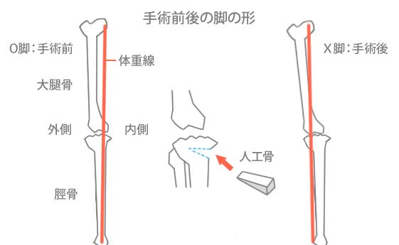 膝の手術の図