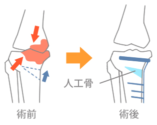 膝の手術の図