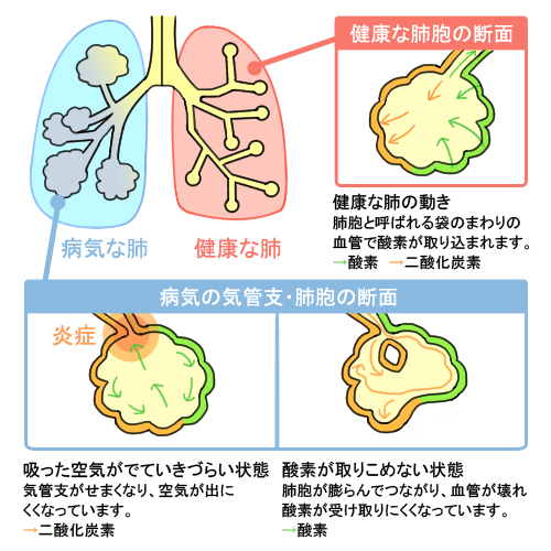 腰部脊柱管狭窄症の病態