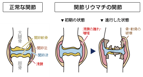 リウマチ