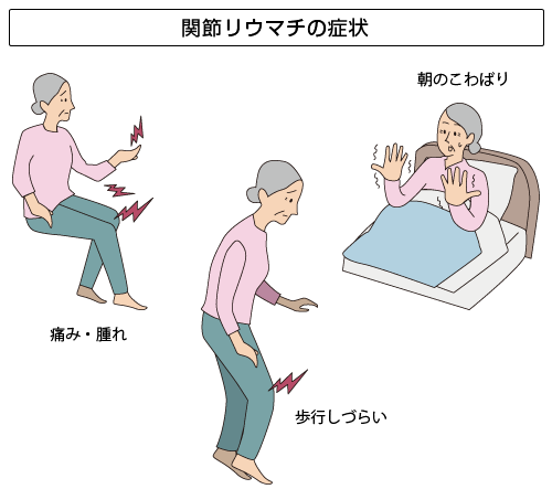 関節リウマチの症状