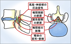 腰部脊柱管狭窄症の病態