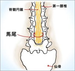 腰椎椎間板障害