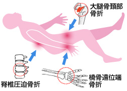 骨粗鬆症で起こる骨折